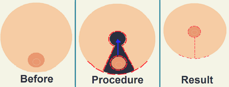 Breast Surgery in Surat