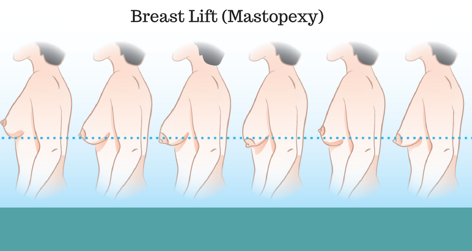 Breast Surgery in Surat