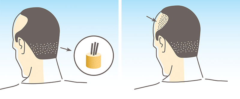 Hair Transplant in Surat