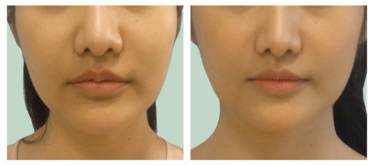 Lip Reduction Surgery In Surat