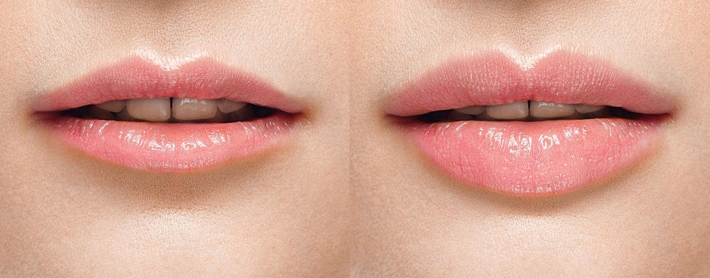 Lip Surgery in Surat