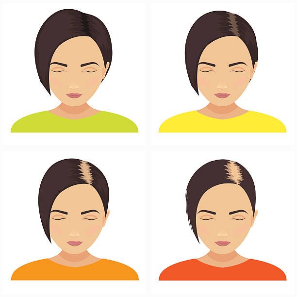 Best hair transplant in surat