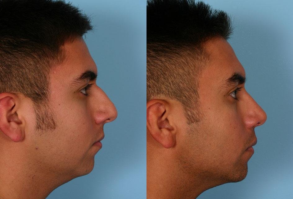 Rhinoplasty in Surat