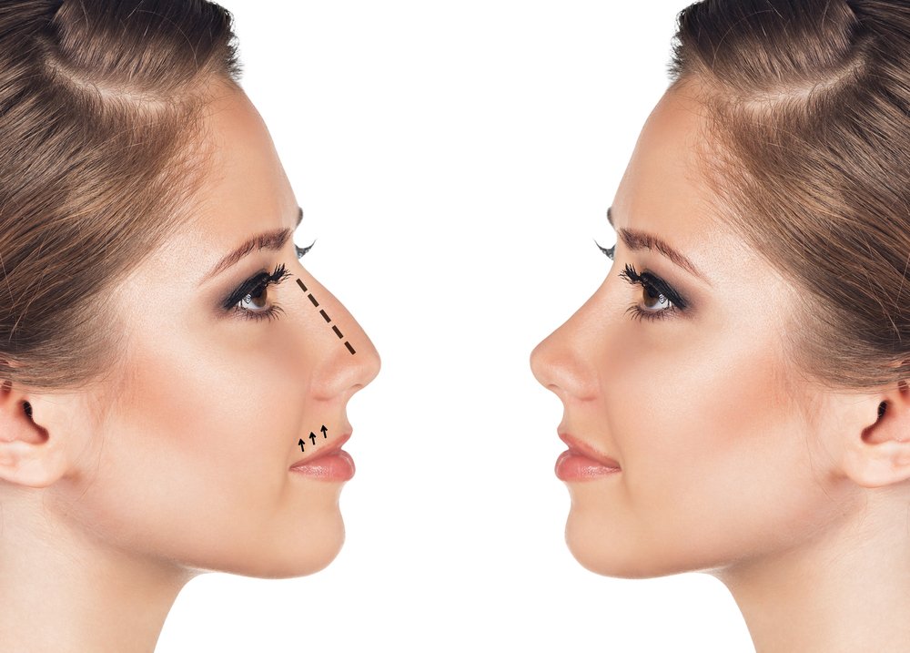 Rhinoplasty in Surat