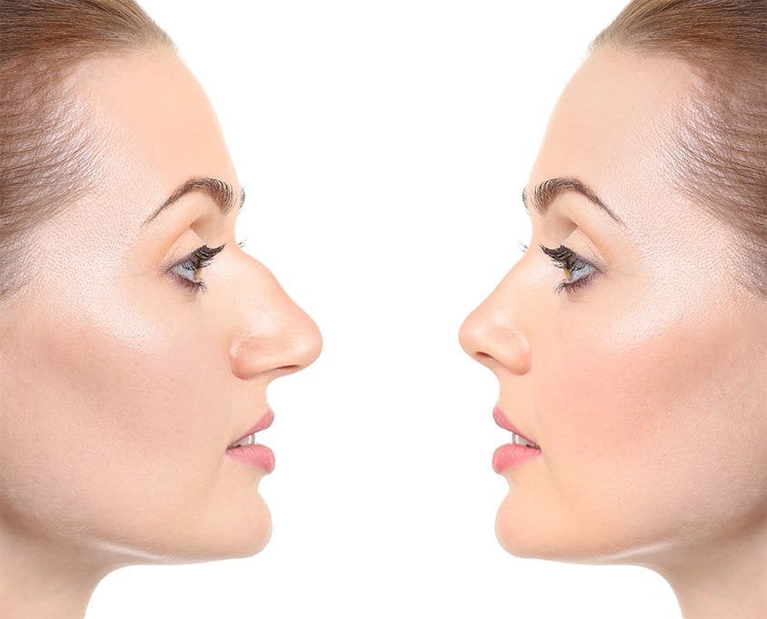 Rhinoplasty in Surat