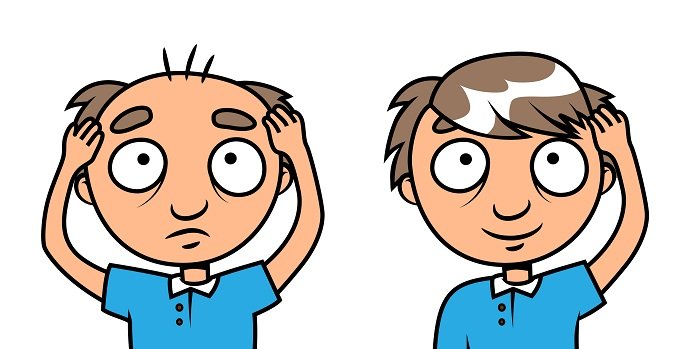 Hair Transplant in Surat