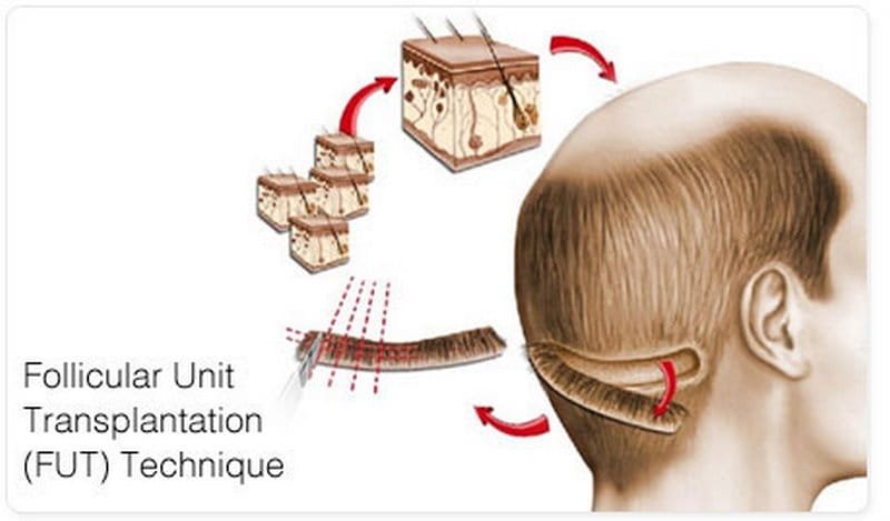 Best Hair Transplant in Surat