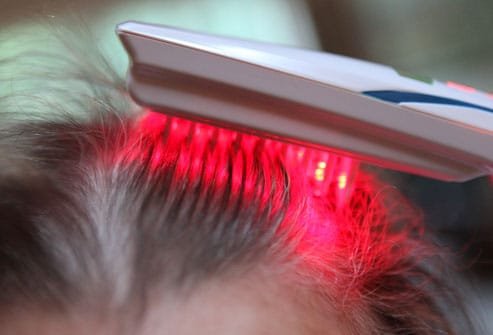 Hair Transplant in Surat