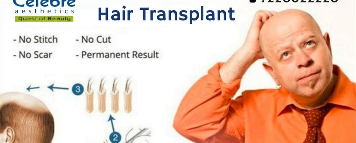Hair-Transplant-in-Surat
