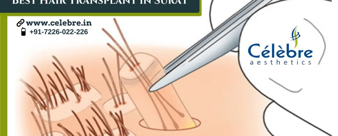 Best-Hair-Transplant-in-Surat