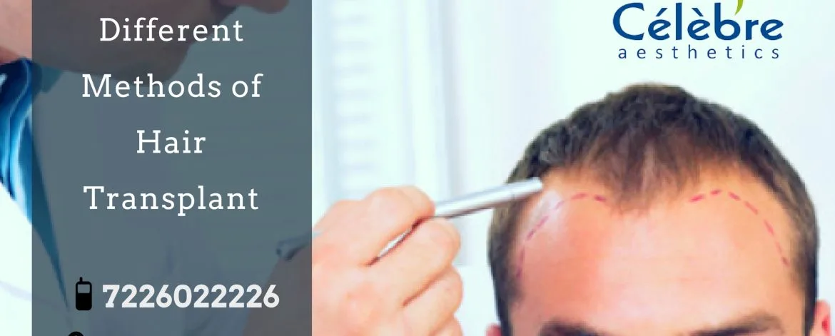 Different-Methods-of-hair-Transplant-1