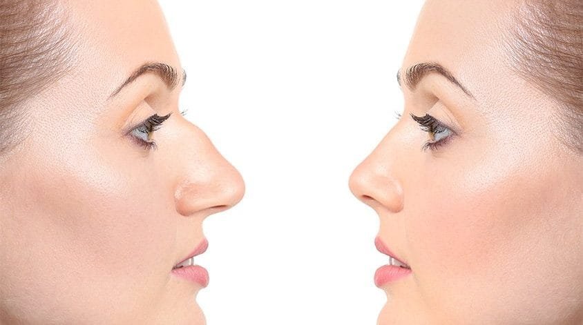 rhinoplasty-1