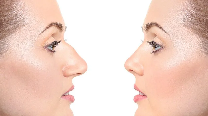 rhinoplasty-1