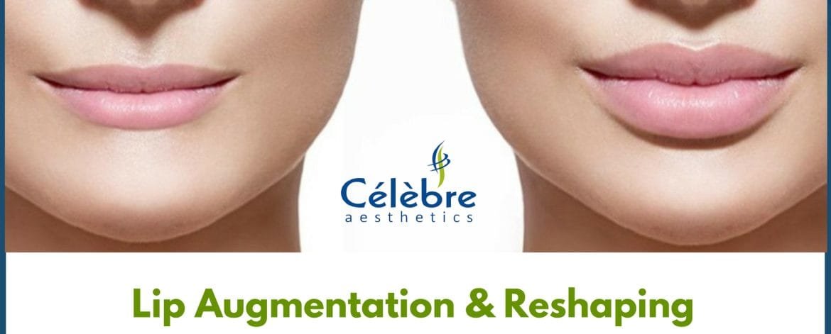 Lip-Augmentation-Reshaping