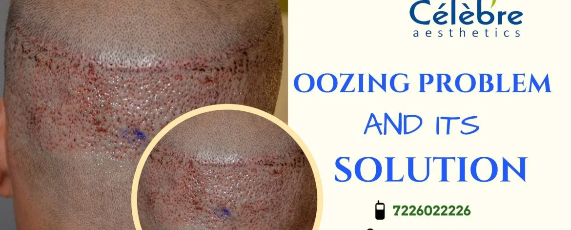 Solution-for-Oozing-Problem-After-Hair-Transplantation