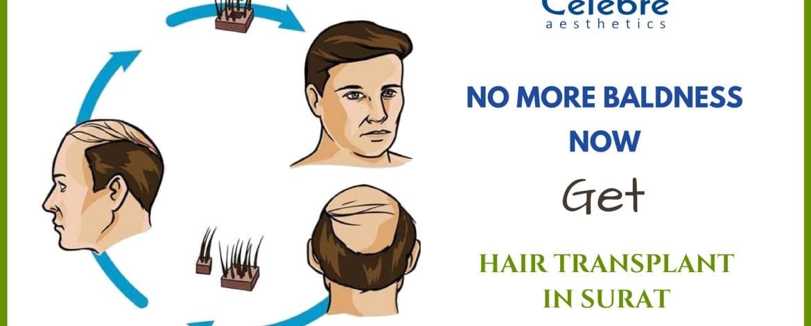 Hair-Transplant-in-Surat-1
