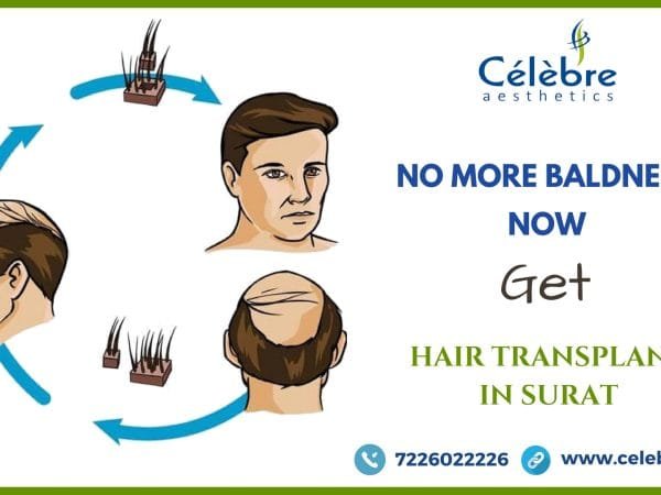 Hair-Transplant-in-Surat-1