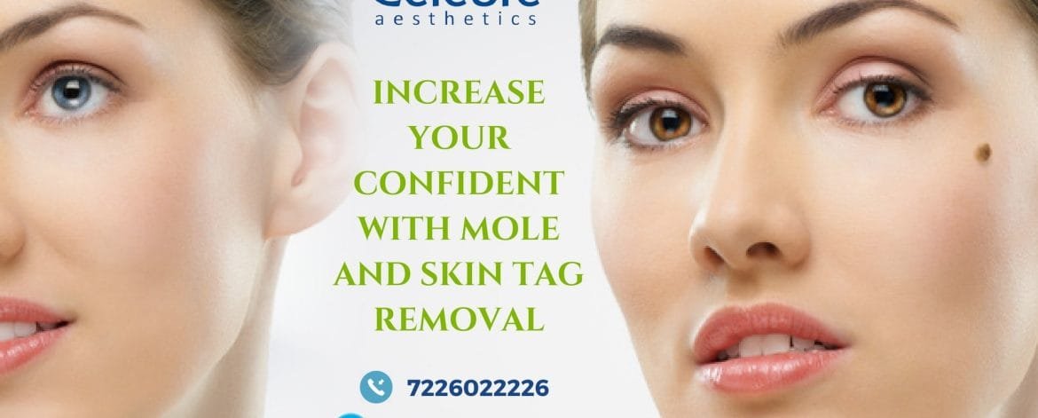 Increase-Your-Confident-With-Mole-and-Skin-Tag-Removal-min