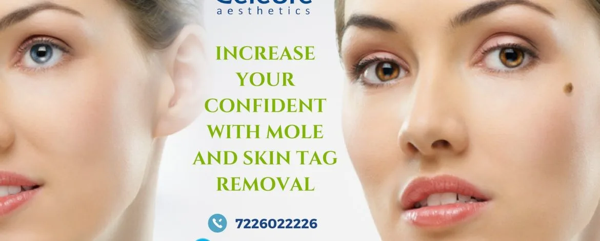 Increase-Your-Confident-With-Mole-and-Skin-Tag-Removal-min