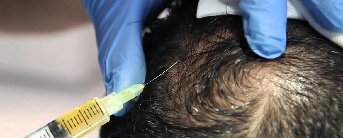Hair-Mesotherapy-in-Surat