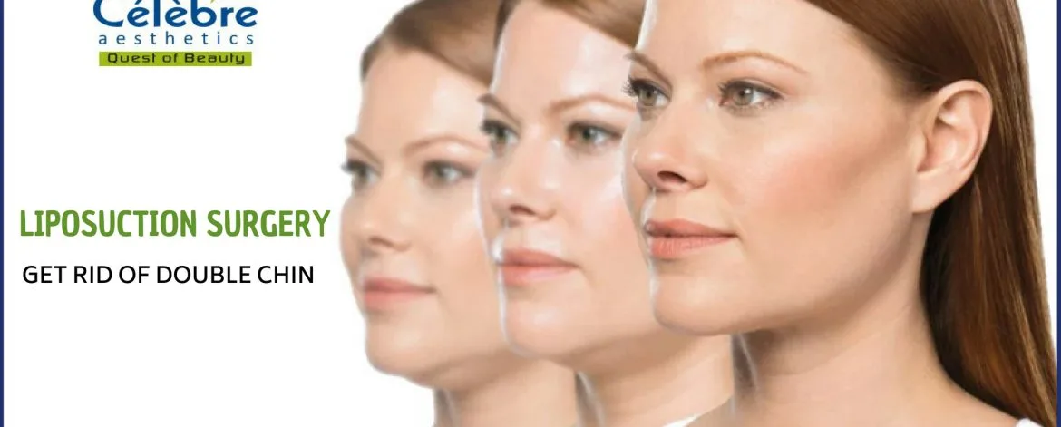 Liposuction-Surgery-in-Surat