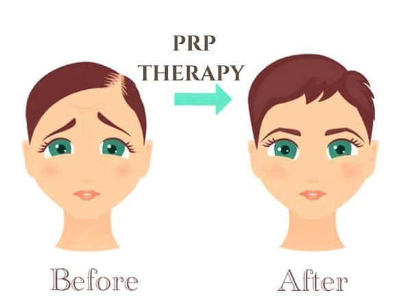 PRP-Therapy