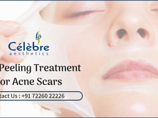 Skin-Peeling-Treatment