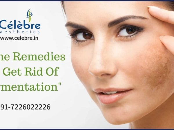 Home-remedies-to-get-rid-of-pigmentation