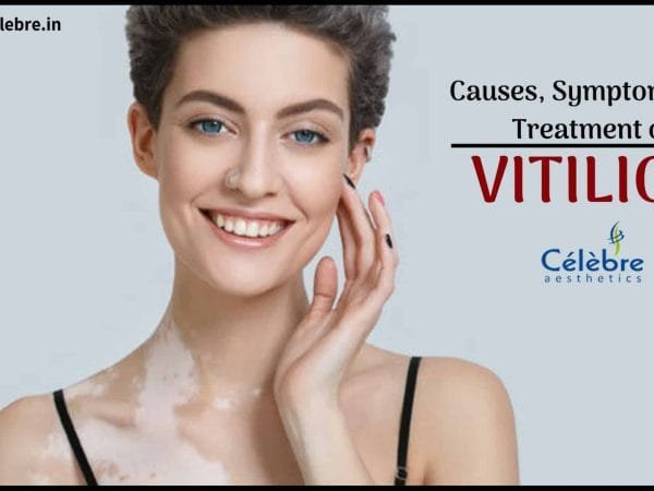 Vitiligo-Treatment