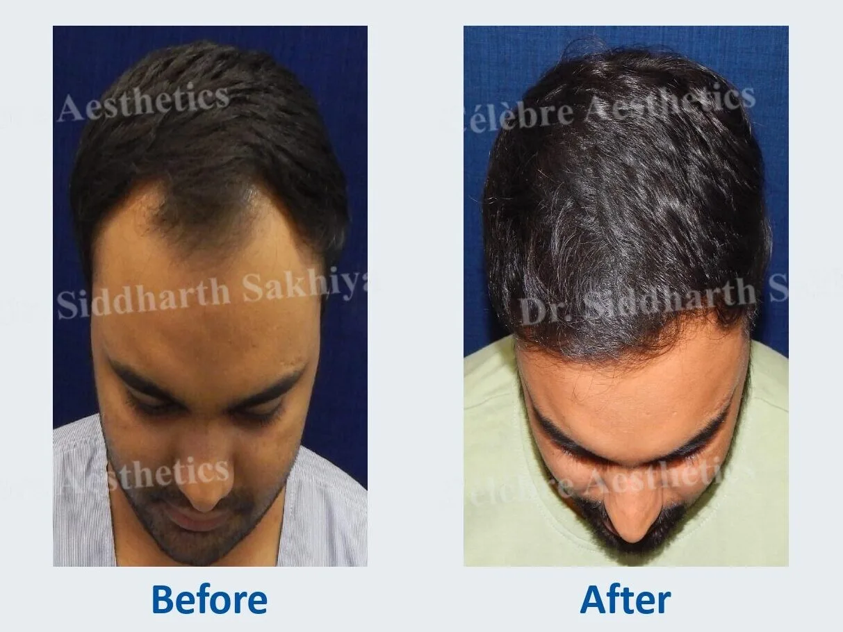 Hair transplant in india