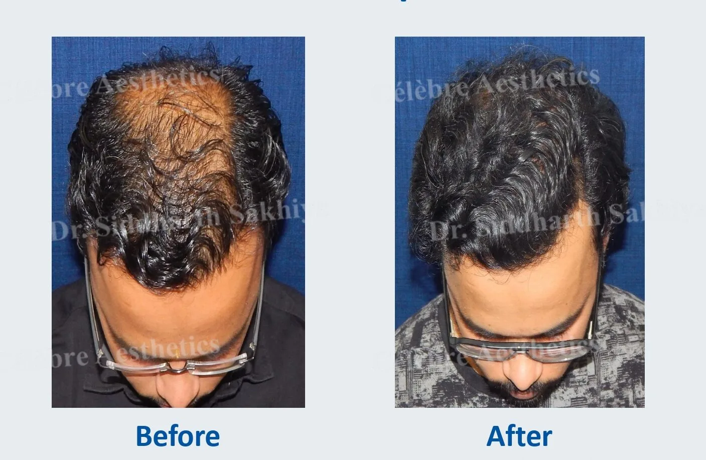 Hair Transplant in India