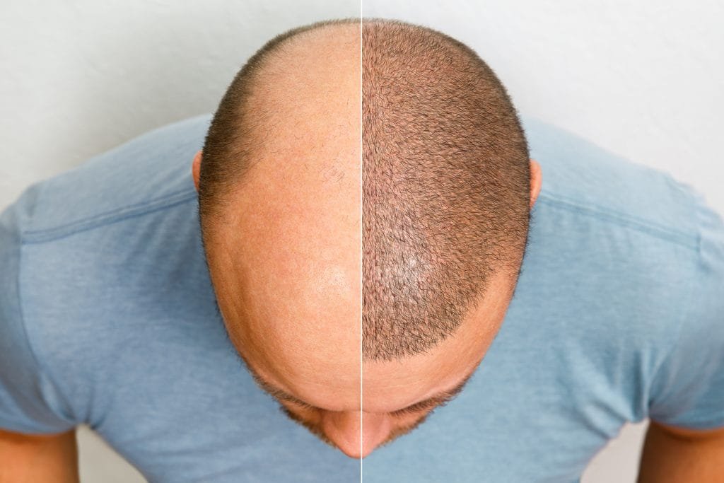 Hair transplant in Ahmedabad