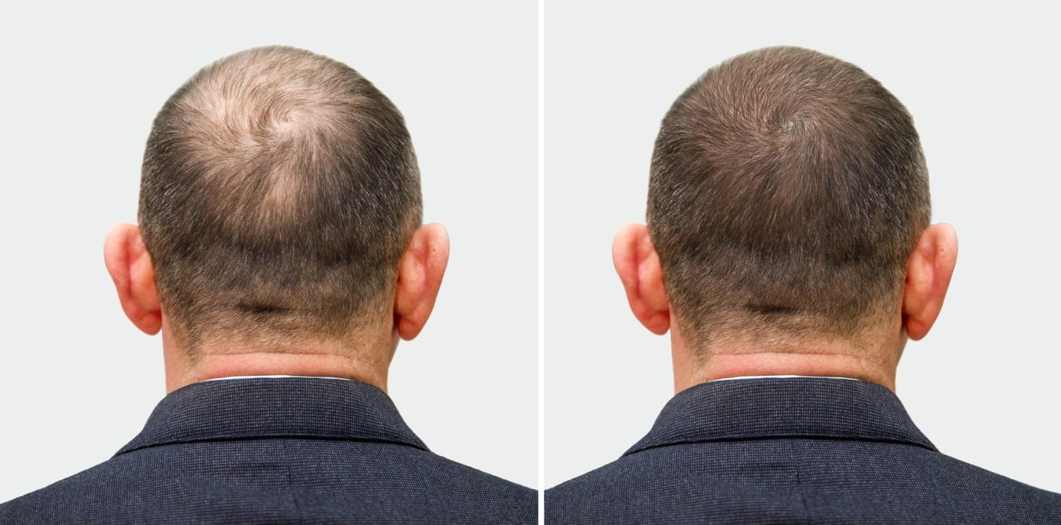 FUT hair transplant
