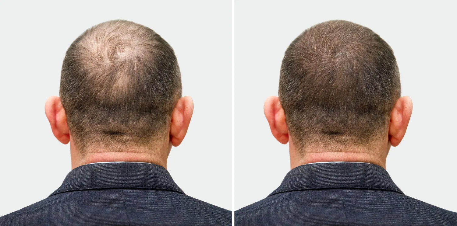 FUT hair transplant