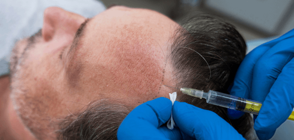 Mesotherapy for hair growth treatment