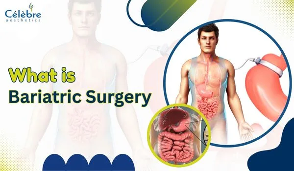 what-is-bariatric-surgery