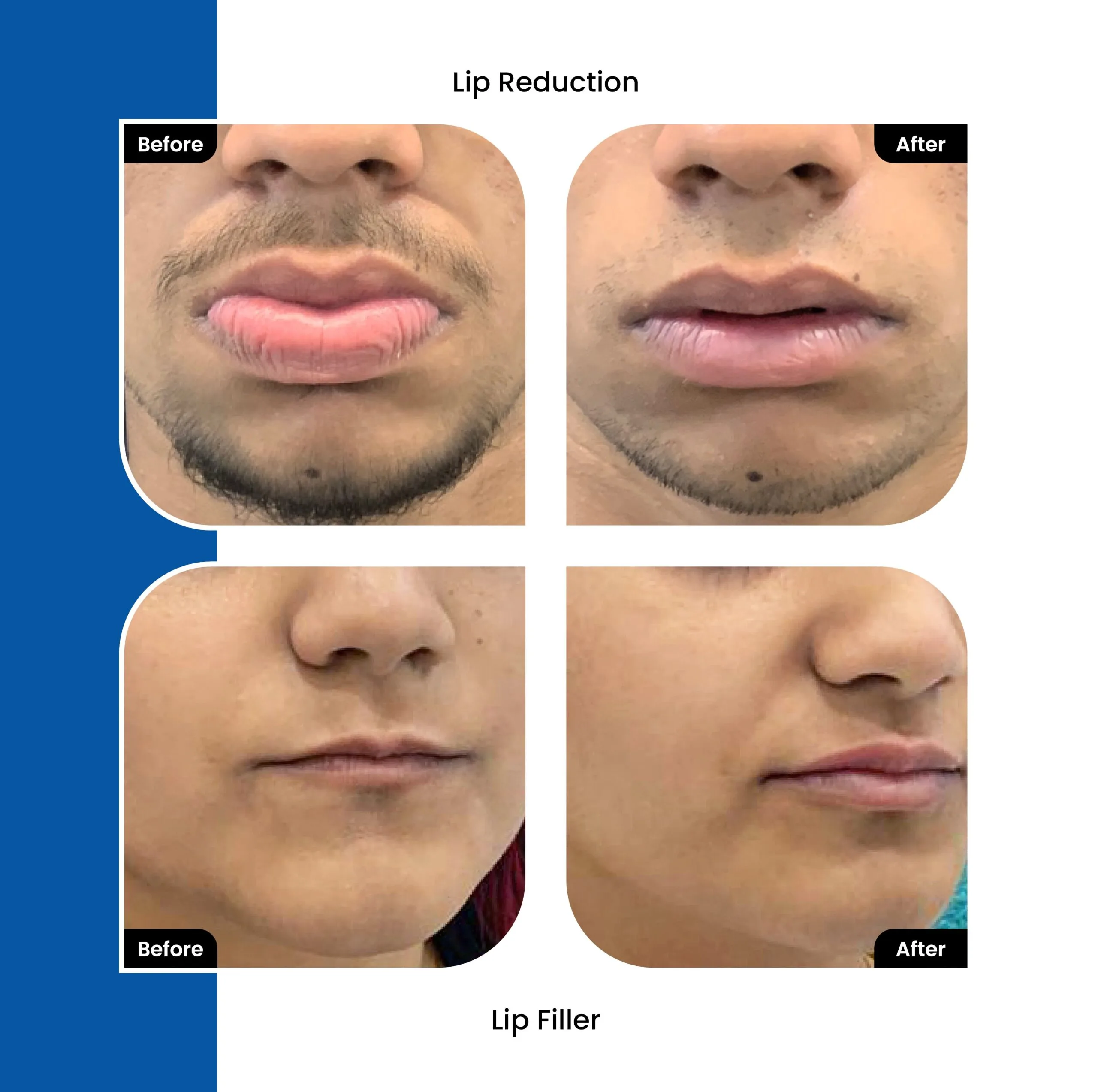 Lip Surgery