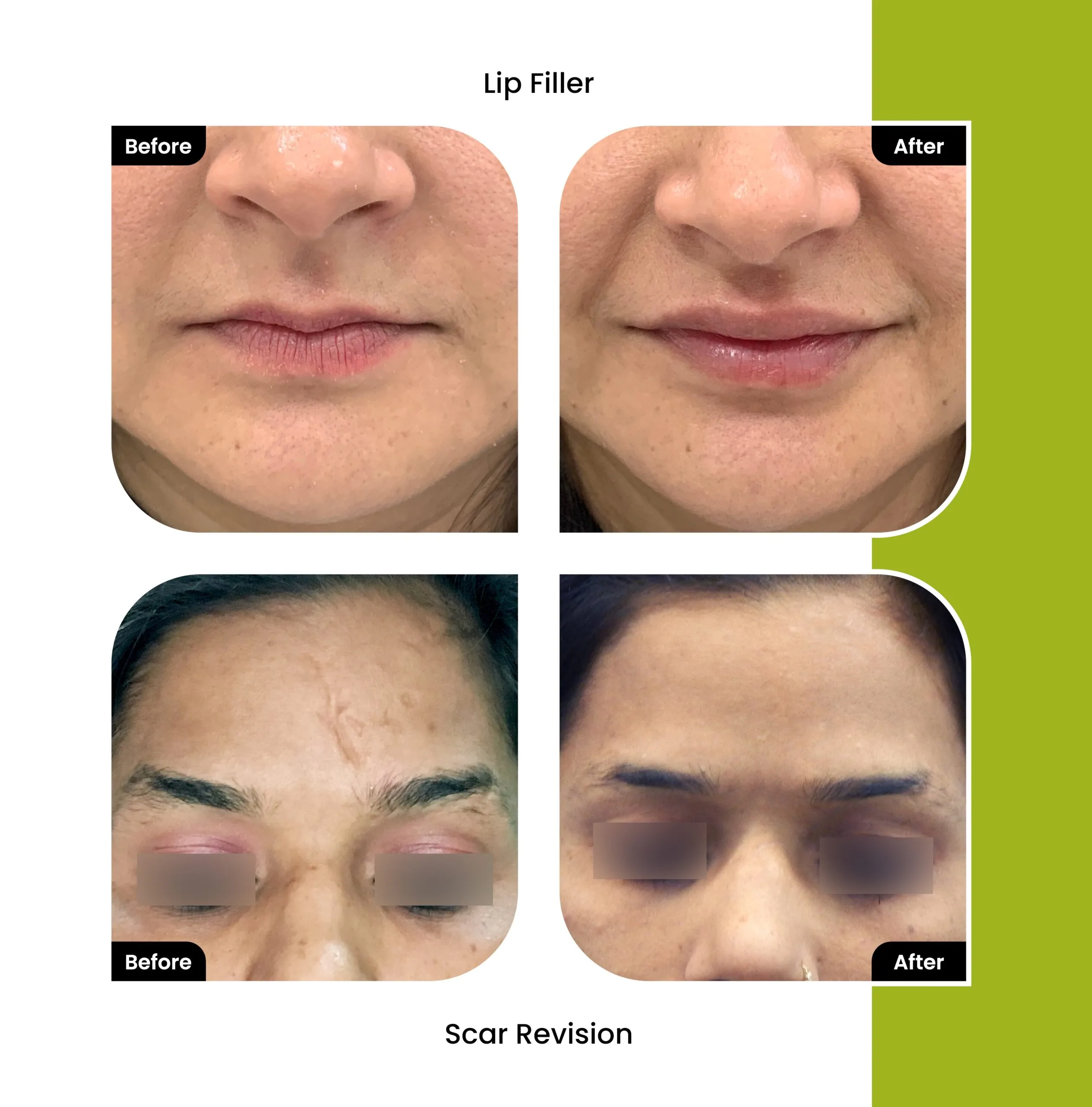 Lip Augmentation Surgery