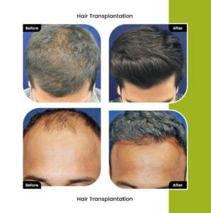 Hair-transplant-in-Rajkot