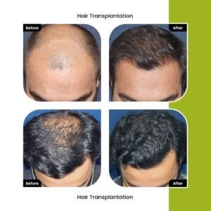 best-hair-transplant-in-surat