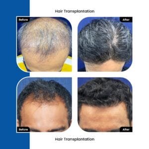 FUT Hair Transplant in Ahmedabad