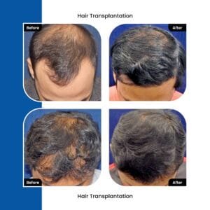 hair transplant results in india