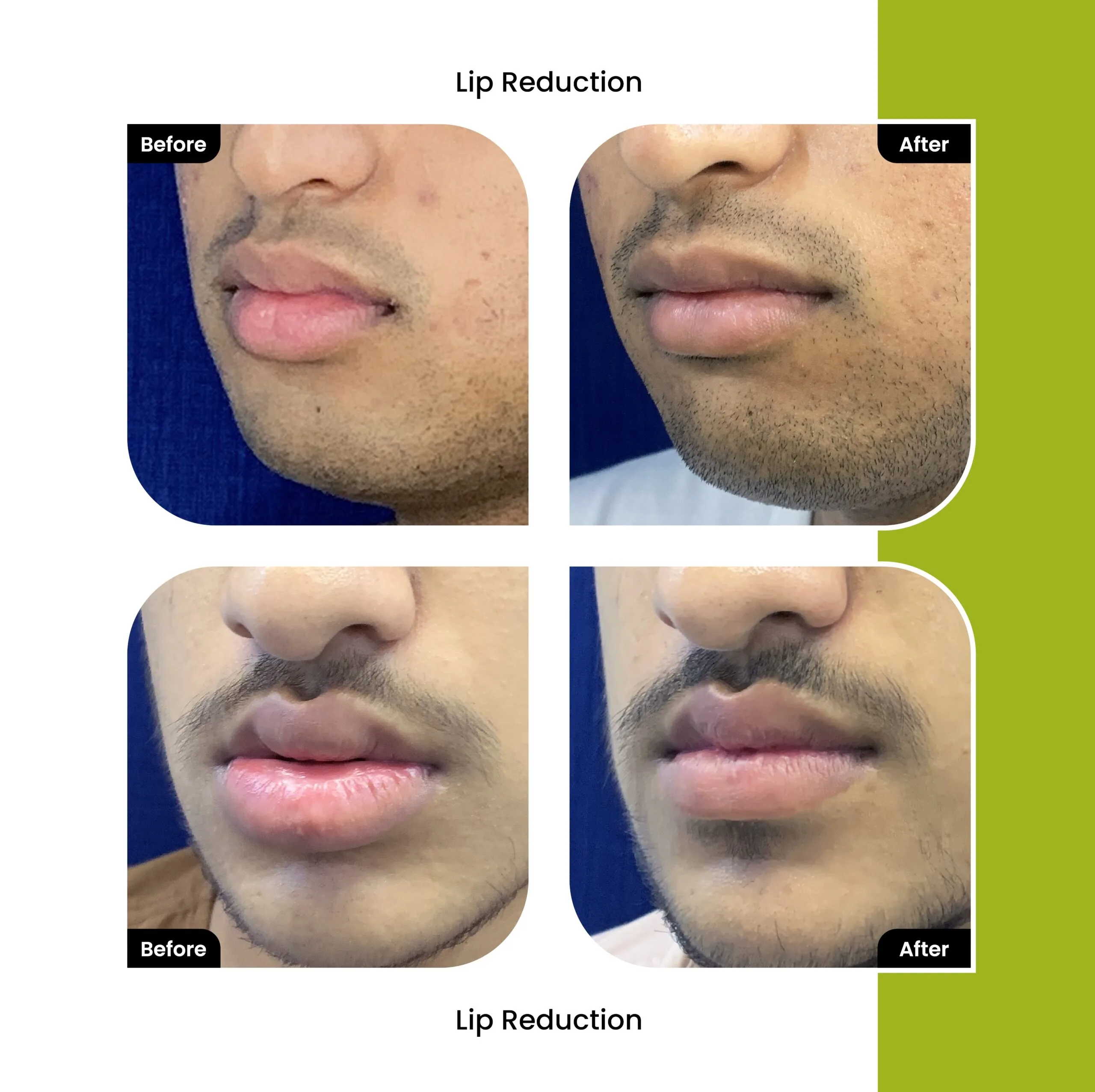 Lip Reduction Surgery