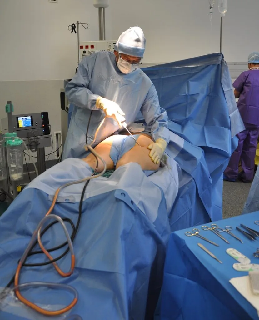 liposuction-fat-removal-surgery-in-surat-ahmedabad-rajkot