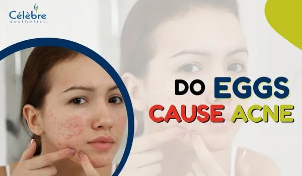 do eggs cause acne?