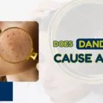 does dandruff cause acne