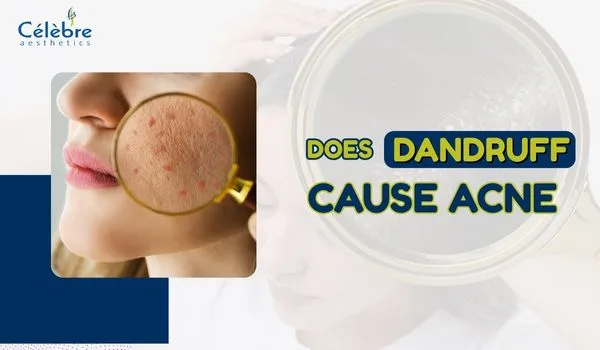 does dandruff cause acne