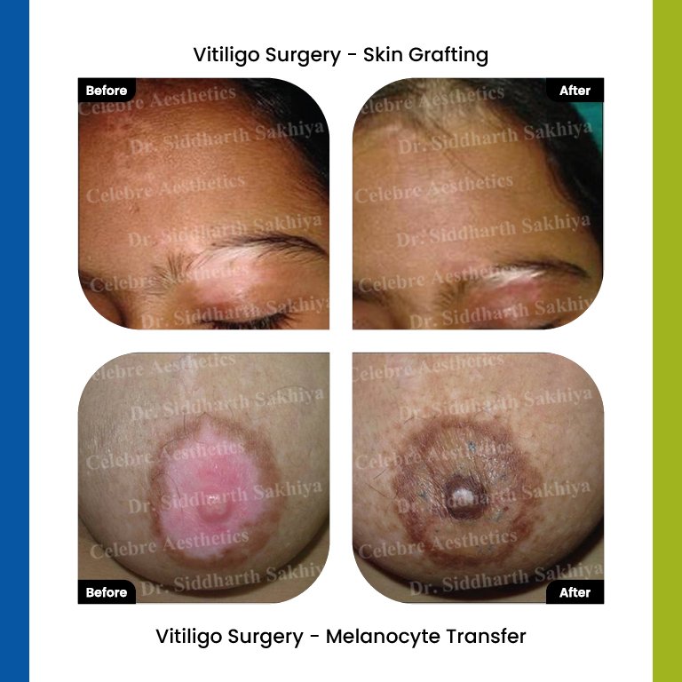 Vitiligo Result 1