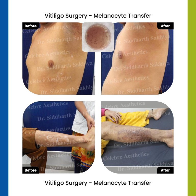 Vitiligo Result 2